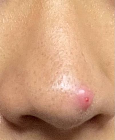 皮膚の病気 アトピー 解決済みの質問 Yahoo 知恵袋