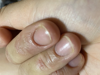 私はアトピー性皮膚炎なのですがこの症状がわかる人教えていただきたいです 爪と Yahoo 知恵袋