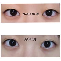 埋没が取れた場合糸はどこにいくのでしょうか そのまま瞼の中に入るのです Yahoo 知恵袋