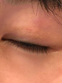 中学生です 瞼のかぶれ アレルギーについてです だいぶ前から瞼がザラザラして Yahoo 知恵袋