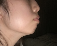 これはアデノイド顔貌でしょうか 口呼吸顎の梅干しジワ鼻の穴が小さいです Yahoo 知恵袋