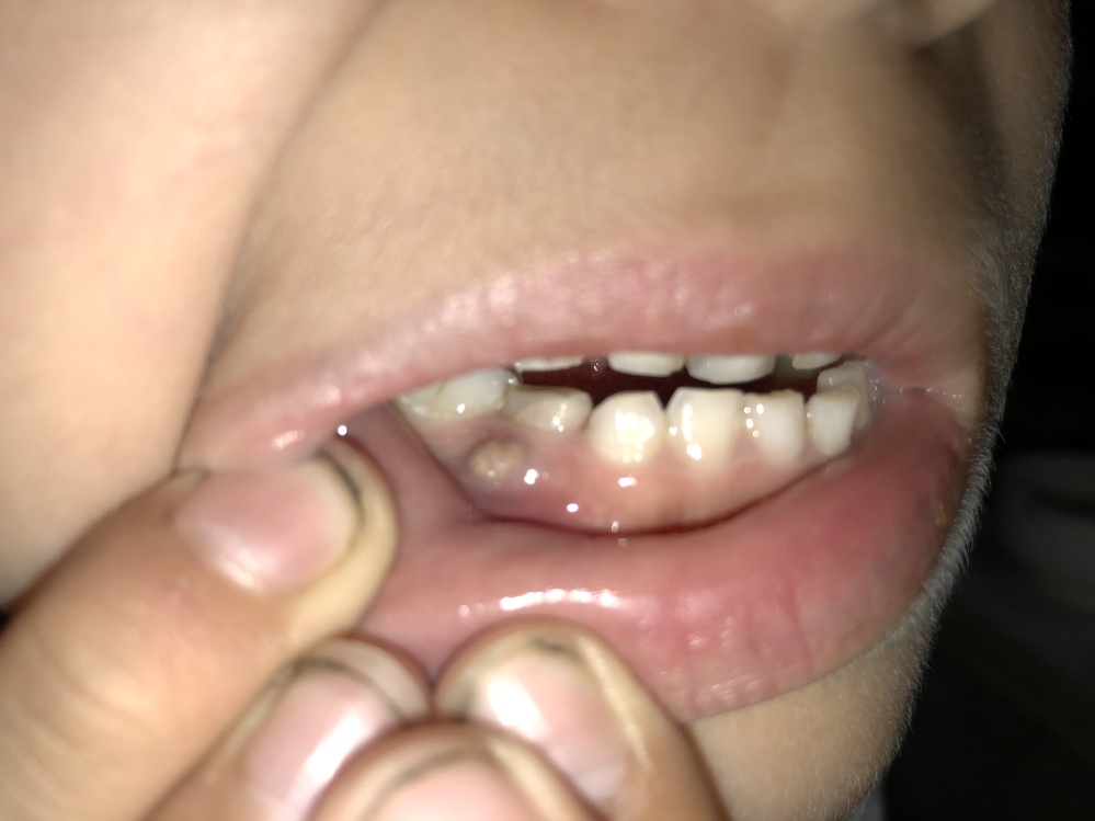 ７歳の子供の歯についてです。写真にあるように、右側の歯茎から歯のよ 