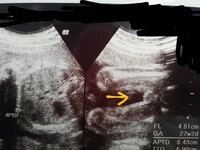 妊娠26週のエコーです 男の子か女の子か どちらに見えますか この Yahoo 知恵袋