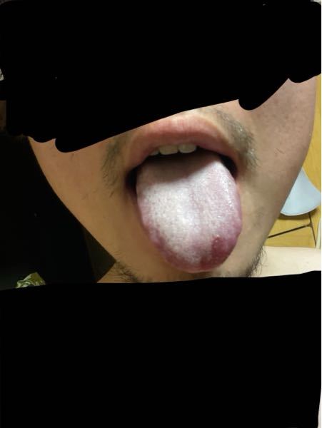 舌の写真を乗せています 汚い物を乗せてすみません舌苔が着きやすくて悩ん Yahoo 知恵袋