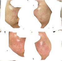 ディフェリンを顔に塗って湿疹ができたあと リンデロンとアズノールの混合をもら Yahoo 知恵袋