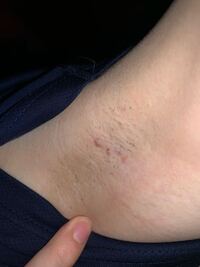 汚いです 脇の画像です でも誰か助けてください 脱毛したら治り Yahoo 知恵袋