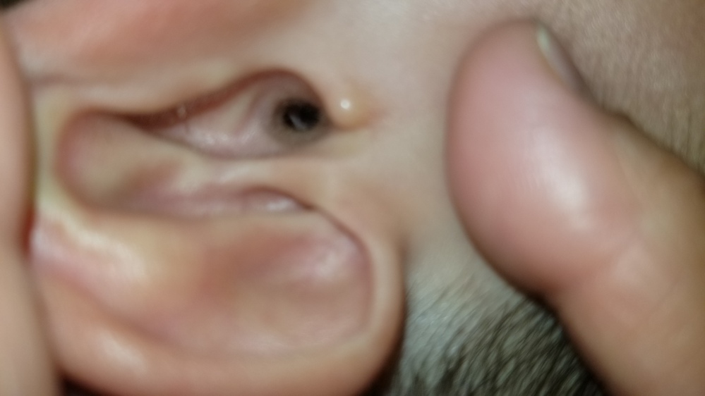 こんばんは ふとした瞬間に 子供の耳を見てみたら鼓膜じゃない場所 Yahoo 知恵袋