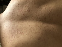 背中ニキビ治したいです 胸もこんな感じです サンソリットっていう石鹸よ Yahoo 知恵袋