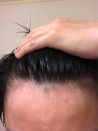 高校三年です友人にはげていると言われます 特にm字のところが薄いと言われます Yahoo 知恵袋