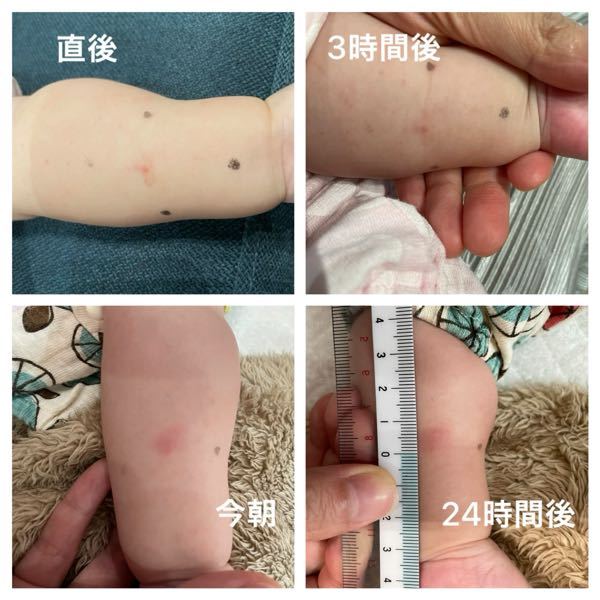 ツベルクリン反応について教えてください 生後５ヶ月の娘がbc Yahoo 知恵袋