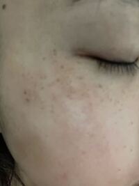23ですこのシミの両普通でしょうか 中学からあって悩んでいます日焼 Yahoo 知恵袋