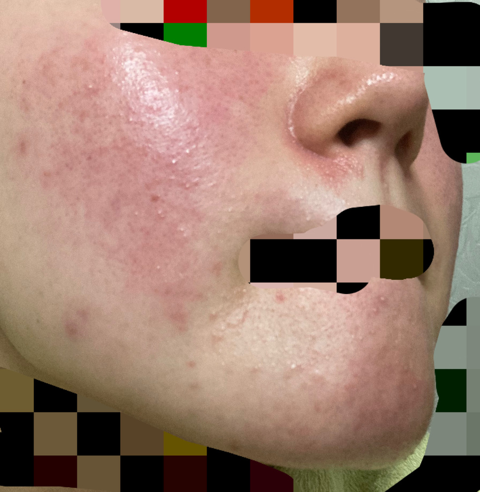 皮膚の病気 アトピー 回答受付中の質問 Yahoo 知恵袋