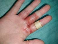 手荒れの写真有 結構やばいので注意 手荒れが酷くて困ってます Yahoo 知恵袋