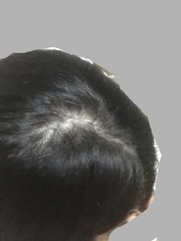 中学生 高校生の頃からのハゲが進行してます 現在大学生の女です 写真は Yahoo 知恵袋