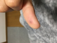 この症状について知りたいです 親指に米粒くらいの大きさの腫れ ふくらみ Yahoo 知恵袋