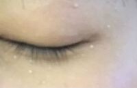 目の周りに白いぶつぶつがあるんですが 牌粒腫というやつですか Yahoo 知恵袋