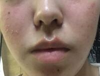 このようなニキビに悩まされていて 美容皮膚科でのピーリング べピオ Yahoo 知恵袋