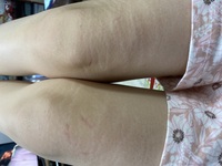 写真を見たらわかると思うんですけど 肉割れがひどいです おしりの Yahoo 知恵袋