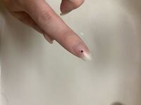 背中に硬い凸があり引っ掻いたら取れたのですが 黒い部分はとても硬く角栓の Yahoo 知恵袋