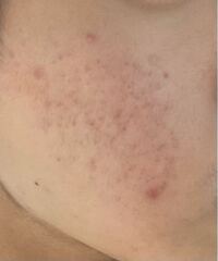 この頬にできたニキビが中々消えなくて困ってます 昔から乾燥肌だったのですが Yahoo 知恵袋