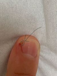 爪の中に緑の膿があります 爪の横にも膿があったので出しました Yahoo 知恵袋