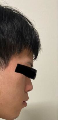 顔面が汚いのとアデノイドです このような場合 どのようにすれ Yahoo 知恵袋