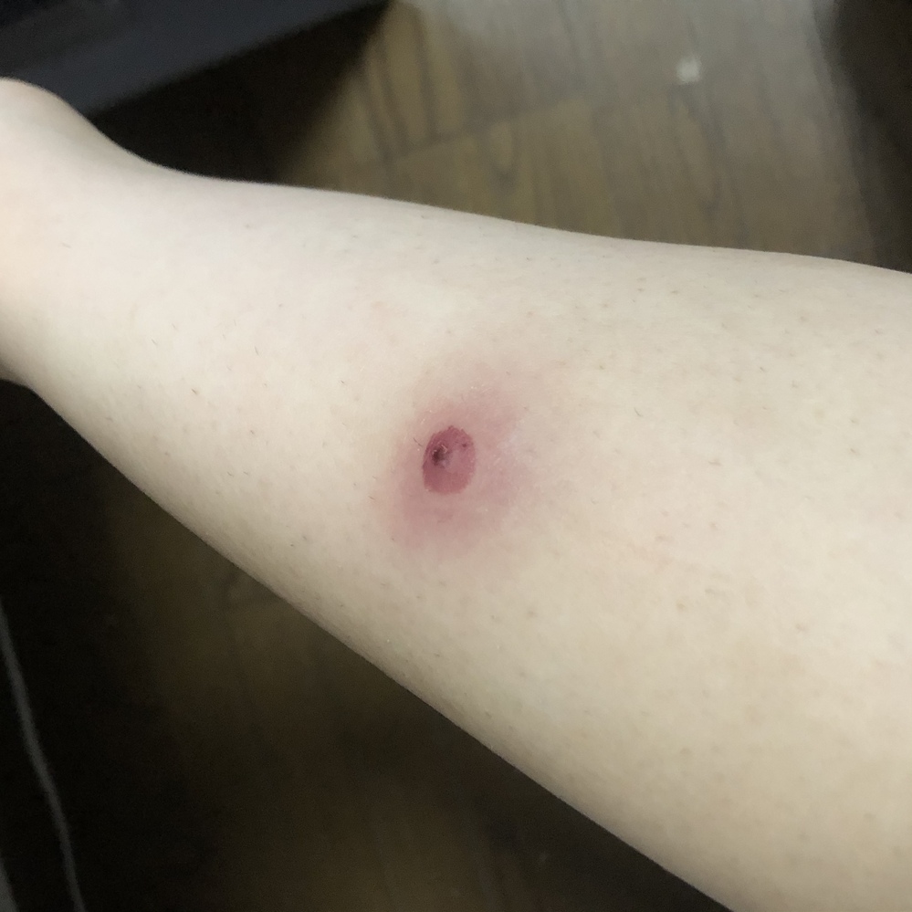 皮膚の病気 アトピー すべての質問 Yahoo 知恵袋