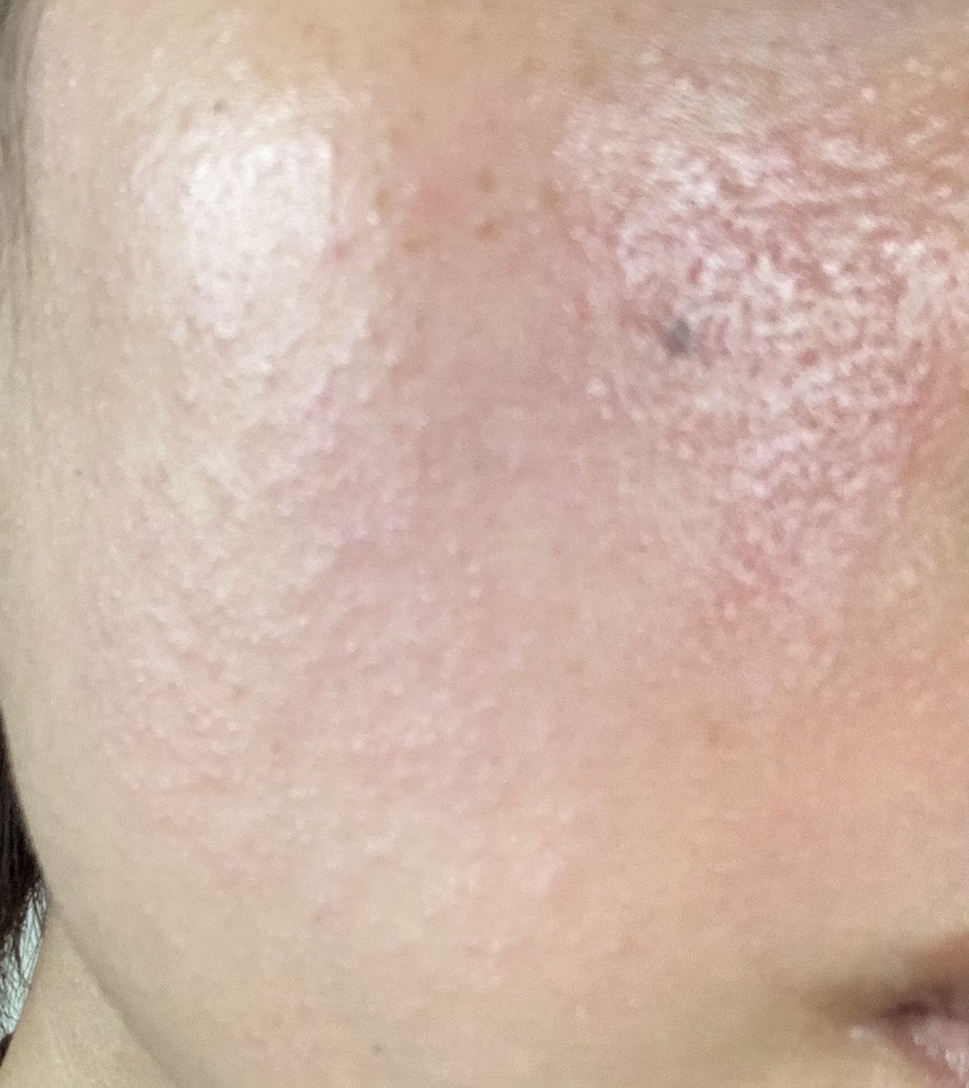 2 3日前朝起きて鏡を見ると顔全体にプツプツとした湿疹みたいなもの Yahoo 知恵袋