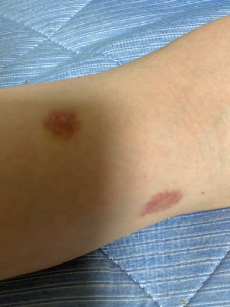 先週くらいからあせものようなできものができて ムヒを塗ったのですがなかなか治 Yahoo 知恵袋