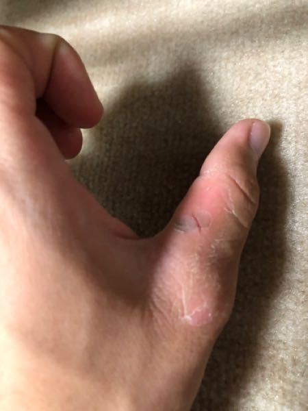 弓道親指の側面 弓と触れる側 が擦れて皮膚がめくれたりぱっくり割れたりします Yahoo 知恵袋