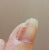 繰り返す爪の亀裂と割れについてこんにちは 私は手の親指の爪がある日 Yahoo 知恵袋