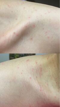 画像のような湿疹 みたいなものが両肩とデコルテにできました お風呂 Yahoo 知恵袋