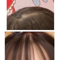 10代女子です つむじと前髪の生え際が薄いのが気になります 改善方法は Yahoo 知恵袋