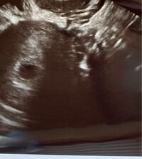 妊娠初期のエコー写真を見て見て頂きたいです 妊娠検査薬で陽性になり先日 Yahoo 知恵袋