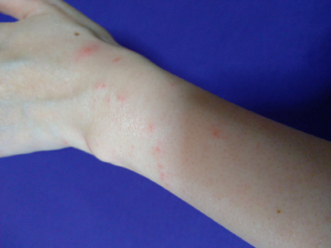 腕の広範囲に急に 赤い湿疹が沢山出来たんですが 何だと思いますか Yahoo 知恵袋