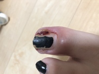 なるべく名古屋駅付近の巻き爪 陥入爪の手術で有名な病院を教えてほし Yahoo 知恵袋