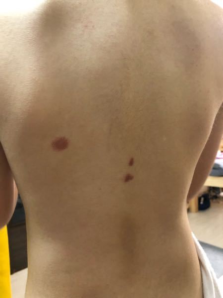 皮膚の病気 アトピー 解決済みの質問 Yahoo 知恵袋