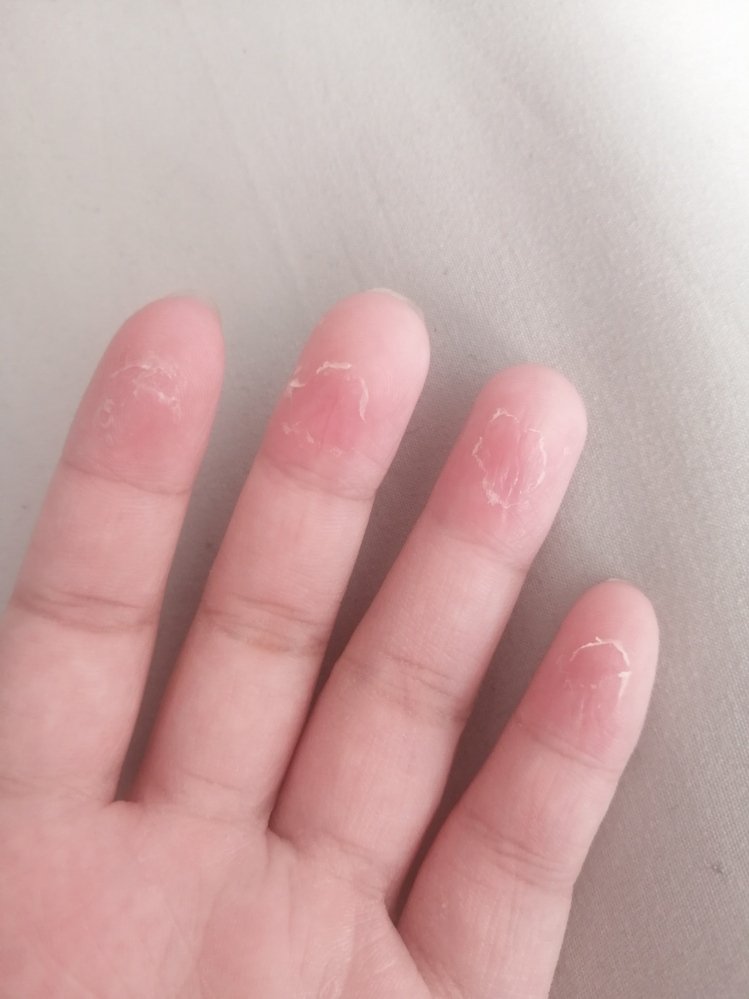 水虫 解決済みの質問 Yahoo 知恵袋