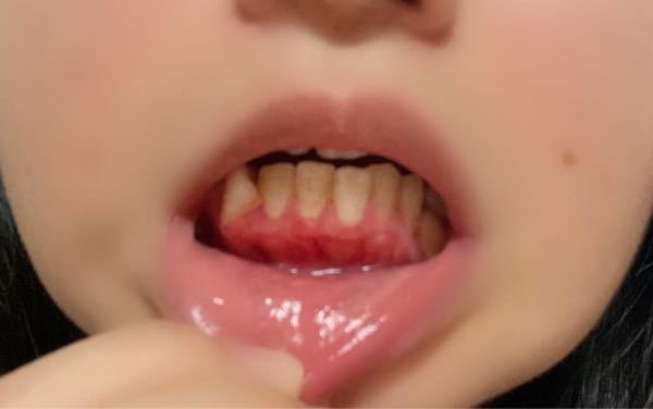 画像ありです 高校生です 歯茎下がりすぎですか 去年の秋に病院に通 Yahoo 知恵袋