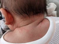 生後60日、これは乳児湿疹ですか？それとも汗疹ですか？首周りひどいです。 