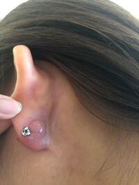 ゲンタシン軟膏について 教えてください 3週間ほど前 虫刺され Yahoo 知恵袋