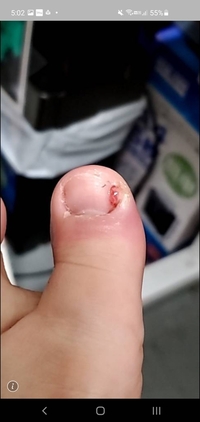 一昨日あたりからささくれをむいたら足が赤く腫れ上がってしまいました 本日仕事 Yahoo 知恵袋