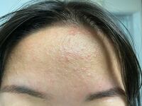 おでこなど肌の凸凹が気になります これはクレーターなのでしょうか 治すにはレ Yahoo 知恵袋