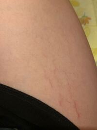 太ももの外側なのですがこれは肉割れですか 見にくくてすみません 実際 Yahoo 知恵袋