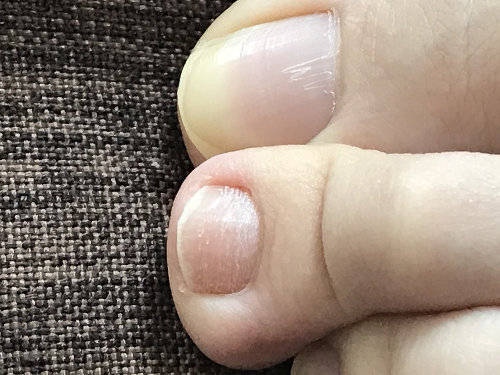 水虫 投票受付中の質問 Yahoo 知恵袋