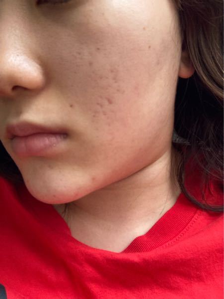 ニキビケア 解決済みの質問 Yahoo 知恵袋