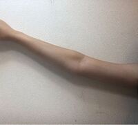 ここ最近ダイエット中なのですが 二の腕が関節より細くなりました そ Yahoo 知恵袋