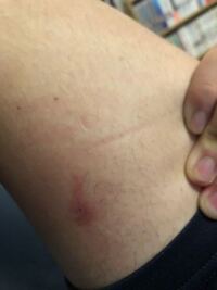 この虫刺されはなんの虫ですか 硬くて押すと痛く 痒いです ム Yahoo 知恵袋