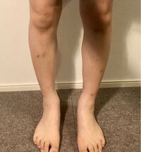 写真ありししゃも足o脚ふくらはぎの痩せ方おしえてください傷跡の治し Yahoo 知恵袋