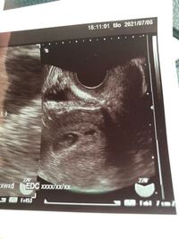 心拍確認本日無事 無事 心拍確認できたのですが 胎嚢の近くに出血が見られるた Yahoo 知恵袋